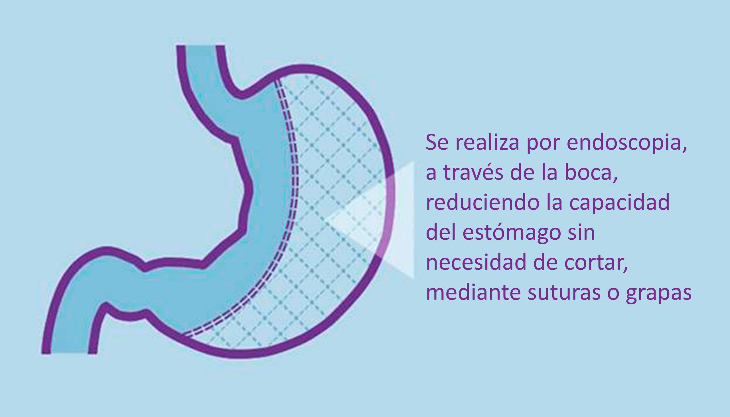 Info Reduccion de estomago por endoscopia junio 2019 scaled - Obesidad L&oacute;pez Nava