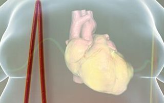 obesidad infarto 0 e1601373749762 - Obesidad L&oacute;pez Nava