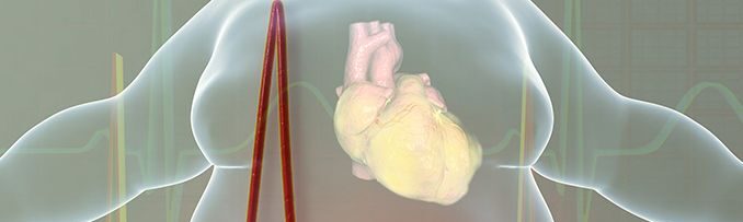 obesidad infarto 0 e1601373749762 - Obesidad L&oacute;pez Nava