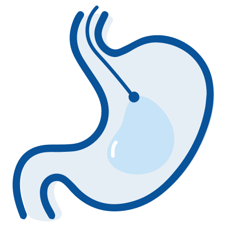 Tratamiento Balón Intragástrico 2 balon gastrico 2 - Obesidad López Nava